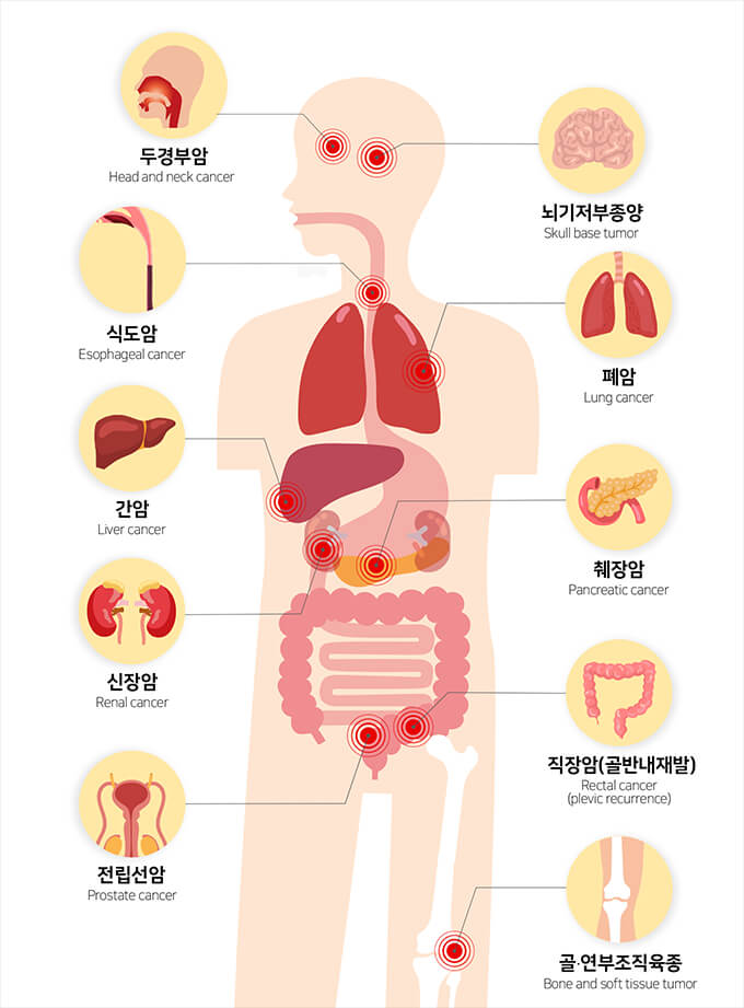 통증 없는 꿈의 암 치료 중입자 방사선 치료 3 중입자치료 가능한 암종